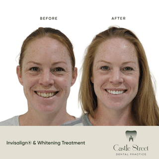 Before and after Invisalign treatment