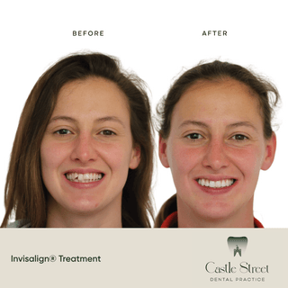 Before and after Invisalign treatment
